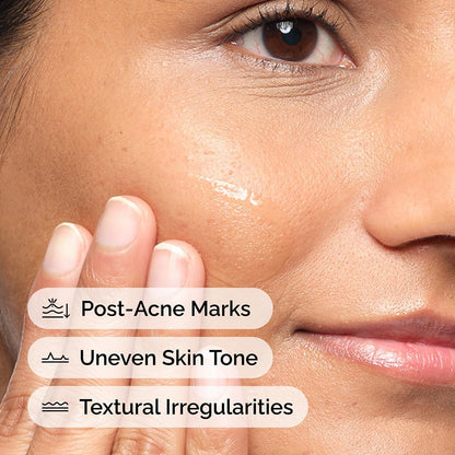 The Ordinary Aloe 2% + NAG 2% Solution, Soothes Skin and Targets Post-Acne Marks, 30ml